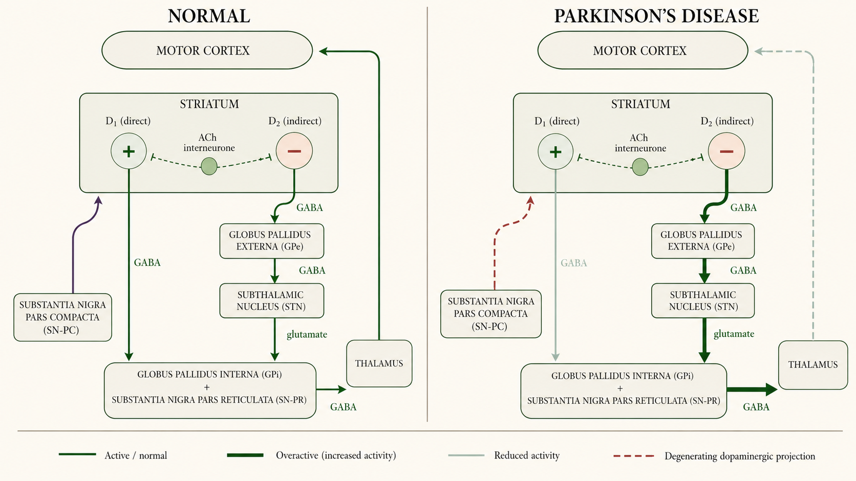 Figure 3 — Basal-ganglia circuitry: normal state vs Parkinson's disease
